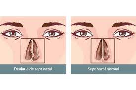 Septul este osul care separă cele două nări. Deviatia De Sept Reginamaria Ro