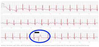 Apple Watch Catches Premature Ventricular Contraction