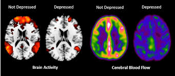 These issues often go undetected or are misdiagnosed, and symptoms can be debilitating for years. Cognition Neuroscience And Mental Health Cook Children S