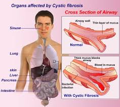 Check spelling or type a new query. Cystic Fibrosis Or Cf Treatment Of Inherited Condition