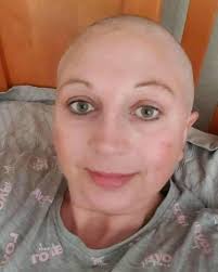 So, for the first time in 5 years of treatment I've finally lost my hair.  This for me was the hardest mentally and I lost it in handfuls