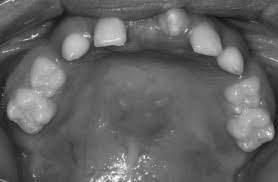 Oligodoncia:  es  la ausencia de seis o más dientes, con un origen que puede estar relacionado con alguna infección materna d