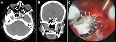 Learn about sphenoid sinus anatomy and its function. Sphenoid Sinus Aspergilloma With Sixth Nerve Palsy Practical Neurology