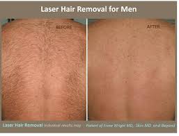 Tattoff focuses on providing the highest quality tattoo removal and laser hair removal services, and is widely regarded as the industry leader for tattoo…. Laser Hair Removal Plano Tx Frisco Tx