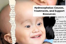 Image result for Hydrocephalus