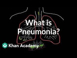 What Is Pneumonia Video Khan Academy