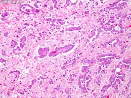 However, pleural mesothelioma accounts for most of the rising number of cases. Malignant Epithelioid Mesothelioma Wild Country Fine Arts