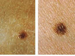 It can be round or oval. How To Check A Mole On Your Skin For Cancer