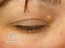 Image result for xanthelasma of eyelid