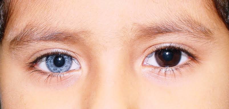 Mga resulta ng larawan para sa Heterochromia in human eyes, one brown and one hazel eyes"