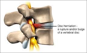This means that rather than the disc, the joint is putting pressure on the soft tissue that. Cervical Herniated Disc Treatment Denver 5280 Cryo Recovery Clinic