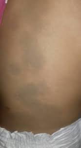 Manchas Verdosas En Toda La Espalda De Mi Bebe Bebes Julio 2016 Babycenter