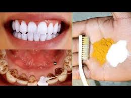 It has low abrasiveness so it's safe to use, and studies show that toothpaste with baking soda is more effective at removing plaque. Pin On Teeth Treatments