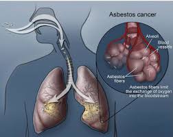 Lung cancer is a serious illness which none of us wish to face. Airborne Fibers Of Asbestos Cause Of Lung Cancer And Mesothelioma Download Scientific Diagram