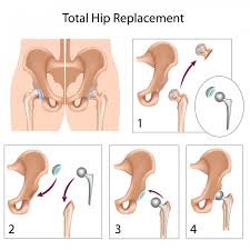 Prevalence Of Cerebral Palsy Higher In Lower Income Rural Areas Hip Replacement Recovery Total Hip Replacement Hip Replacement Surgery