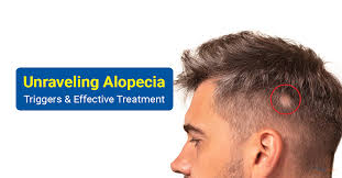 Image result for Alopecia