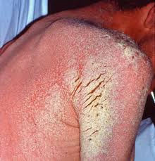 Image result for skin rash acute hiv infection