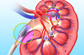 Surgical Treatment Of Kidney Stones Dr Prabhat Ranjan Paras Hmri Hospital Patna