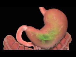 Health Literacy Video Stomach Ulcer Stomach Ulcers Health Literacy Stomach Ulcers Symptoms