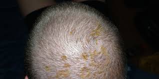Most people don't even know if. Sunburned Scalp Album On Imgur
