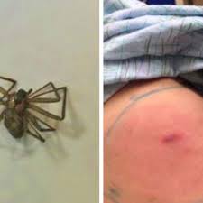 Image result for spinne biss haut reaktion