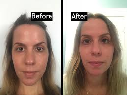 Additional fraxel cases are available for viewing in our offices. Fraxel 411 What It S Actually Like To Get Fraxel Laser Treatment Self