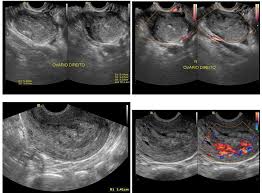 ULTRASSONOGRAFIA EM GINECOLOGIA E OBSTETRÍCIA
