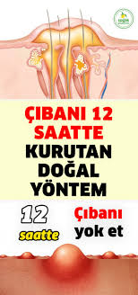 Cibani 12 Saat Icinde Dogal Yontemler Kullanarak Evinizde Kurutabilirsiniz Nasil Mi Ciban Sivilce Cilt Saglik Kadin Saglik Dogal Saglikli Cilt Bakimi