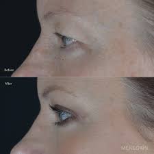 Upper eyelid surgery is one of the...