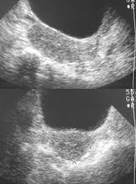 Normal female pelvic ultrasound images. Radiology In Ped Emerg Med Vol 4 Case 8