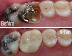 Broken Tooth Call Today And Have Your Crown Done In One Appointment With Cerec Technology Cerec Samedaydentistry Broken Dentistry Dental Dental Website