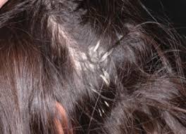 Valitse kuva aakkosellisesta riippuvalikosta tai Is This A Dermatophyte Infection Of The Scalp Consultant360