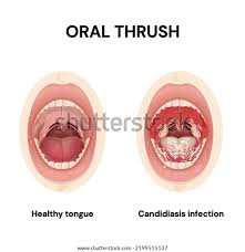Image result for oral thrush symptoms roof of the mouth