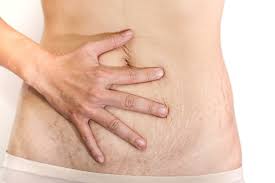 Some people have loose, baggy, skin after weight loss. How To Tighten Loose Skin After Pregnancy Without Surgery Every Mother