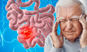 Colon cancer is cancer of the large intestine (colon), which is the final part of your digestive tract. Bowel Cancer Symptoms Signs Include Dizziness And Tiredness Express Co Uk