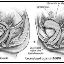 One or both müllerian ducts may not develop fully, resulting in: Pdf Mullerian Agenesis Embryologic And Clinical Significance