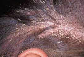 La dermatite seborroica è un disturbo che va a colpire il cuoio capelluto e causa prurito, desquamazione, rossore e forfora. Dermatite Seborroica Rimedi Come Curare La Dermatite Seborroica