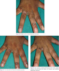 How to use recalcitrant in a sentence. Indian Journal Of Dermatology Venereology And Leprology Evaluation Of Efficacy And Safety Of Intralesional Bleomycin In The Treatment Of Common Warts Results Of A Pilot Study