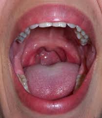 Inside Mouth Eczema Remedies Ulcer Remedies Mouth Natural Eczema Remedies