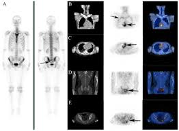 Physicians should consider performing a bone marrow biopsy to diagnose bone marrow metastasis and treat patients with palliative chemotherapy at an earlier phase of the disease. 18f Fluorodeoxyglucose Imaging Of Primary Malignant Pericardial Mesothelioma With Concurrent Pericardial And Pleural Effusions And Bone Metastasis A Case Report