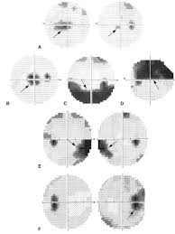 Image result for Visual Field Deficit