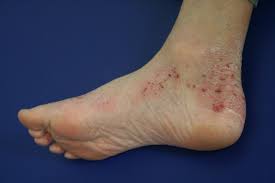 Image result for Atopic Dermatitis