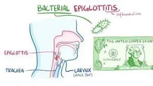 Image result for Epiglottitis