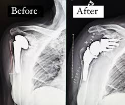 Image result for Shoulder XRay