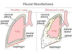 There are many treatments available for the various stages of lung cancer today. Pleural Mesothelioma Cancer Is Also Known As Cancer Of The Lung Lining Mesothelioma