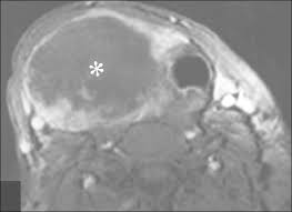 Anaplastic thyroid cancer is the most aggressive thyroid cancer. 63 Year Old Man With Anaplastic Thyroid Cancer Contrast Enhanced Download Scientific Diagram