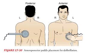 Simply, they go on the front (anterior) of the chest, one above the right nipple. Cardioversion And Defibrillation Adjunctive Modalities And Management