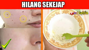 Saya tidak tahu bagaimana di klinik yang lain. Cara Menghilangkan Tahi Lalat Secara Cepat Dengan 2 Bahan Ini Saja Youtube