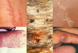 Image result for scabies human bites
