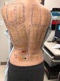 Psa Get Patch Testing Done This Changed My Life 35 Years Of Eczema Breakouts Were Actually Allergic Contact Dermatitis Eczema